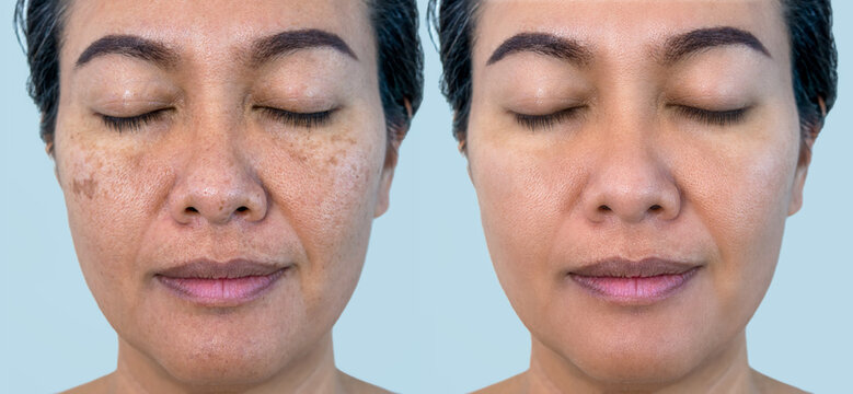 sun damage treatment
